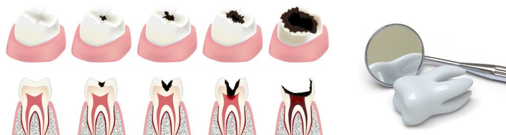 tooths